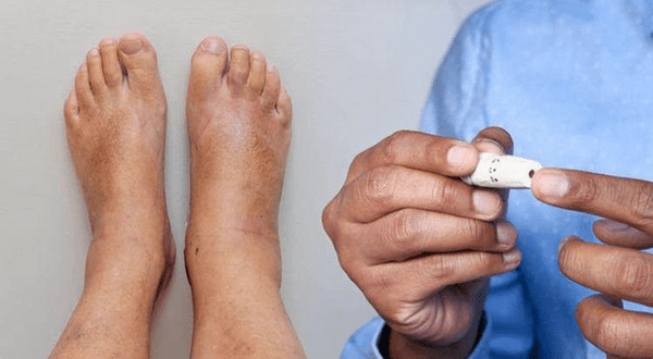 Diabetes: 5 Warning Signs of Foot Problems Due to High Blood Sugar Level