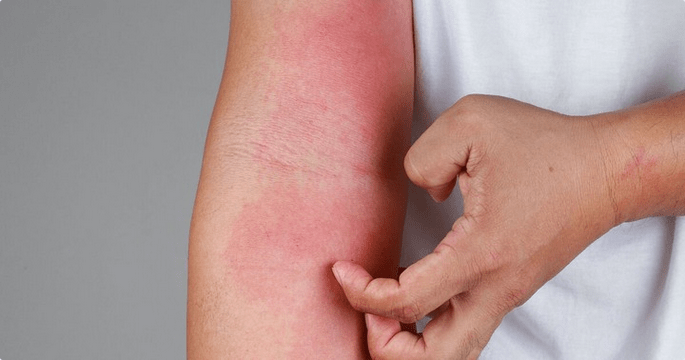 Stay Away From These Foods to Help You Prevent Dry Skin and Eczema