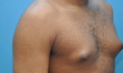 It’s abnormal for men to have big breasts – HEARD VOICE NEWS ONLINE