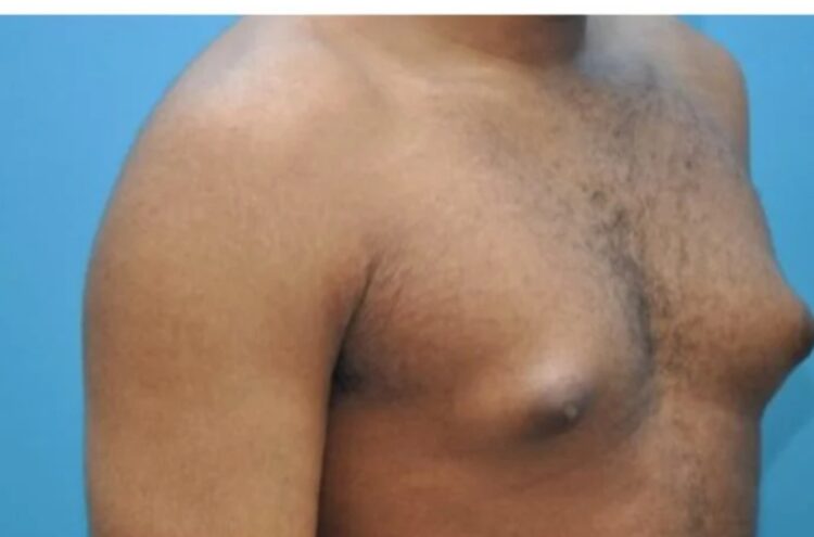 It’s abnormal for men to have big breasts – HEARD VOICE NEWS ONLINE