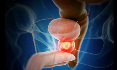 Avoid Prostate Cancer It Suddenly Kills, Stop Eating These 4 Foods In Excess