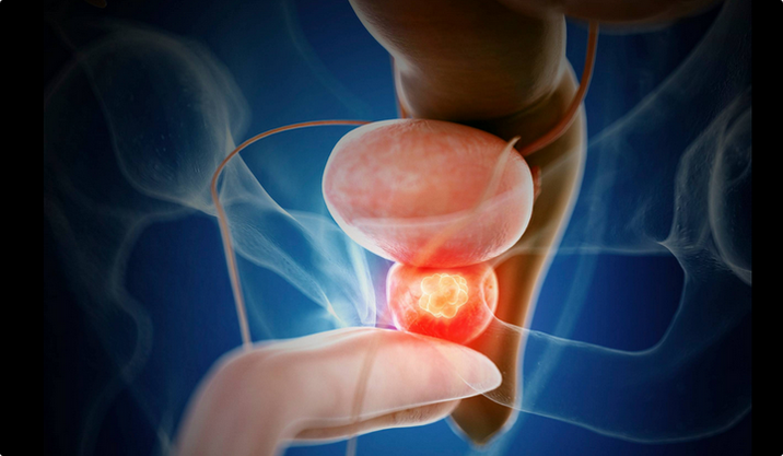 Avoid Prostate Cancer It Suddenly Kills, Stop Eating These 4 Foods In Excess