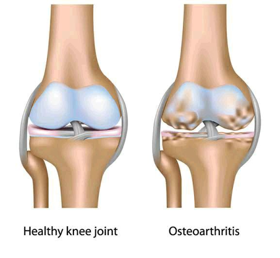 Heal Your Knees And Rebuild Your Bones And Joints With This Powerful Mixtures